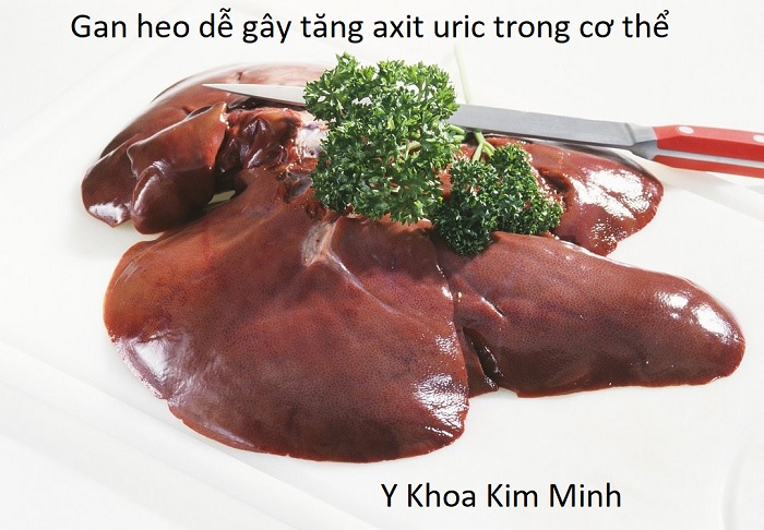 Ăn gan heo dễ gây tăng axit uric và nguyên nhân gây bệnh gout - Y Khoa Kim Minh