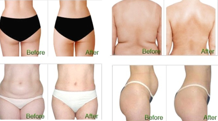 Giảm b&eacute;o cấp tốc bằng c&ocirc;ng nghệ quang đ&ocirc;ng kết hợp caviation40K RF đa cực