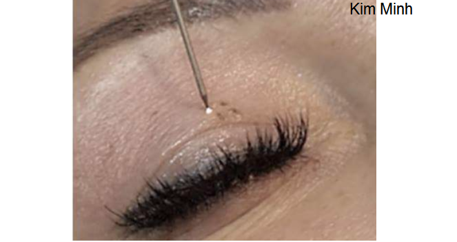 HDSD may nhan mi cong nghe plasma pen y khoa kim minh ban tai tp hochiminh