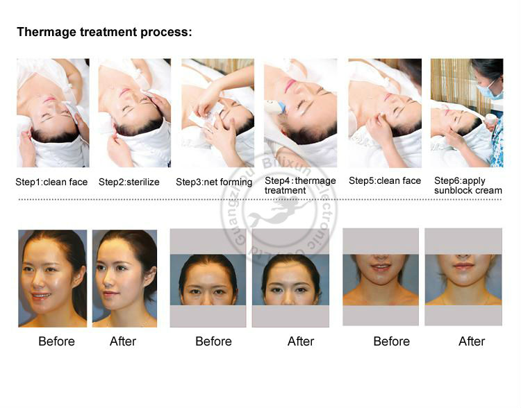 HDSD m&aacute;y RF mini l&agrave;m trắng s&aacute;ng da trị mụn