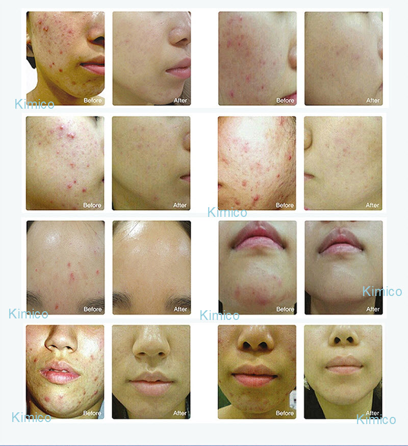 Ket qua dieu tri cham soc da bang den anh sang sinh hoc 7 mau omega light omelon Kim Minh 0933455388