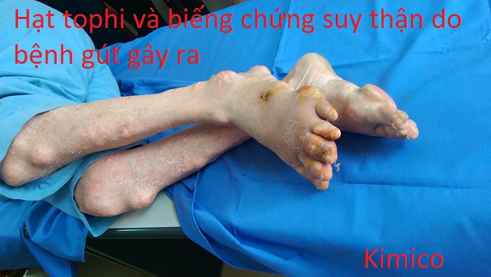 Hạt tophi của bệnh gout gây biến chứng suy thận - Y khoa Kim Minh