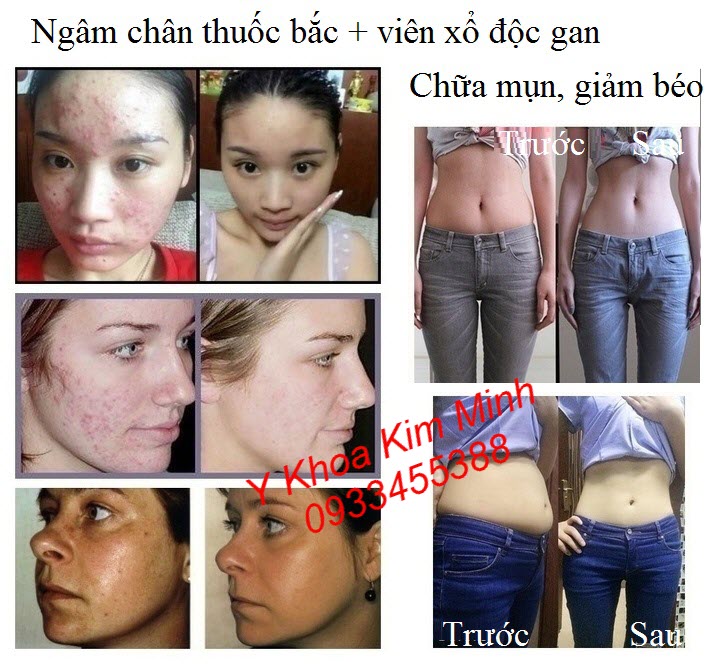 Hiệu quả thải độc da bằng việc ngâm chân thuốc bắc có tác dụng chữa mụn, giảm béo, trị nám toàn diện - Y khoa Kim Minh