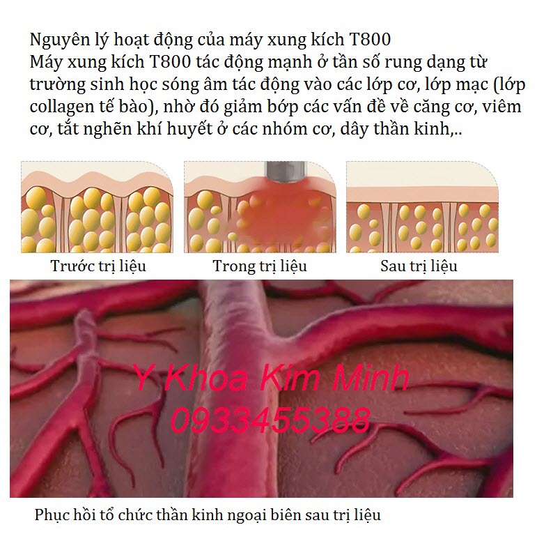 Kết quả trước và sau điêu trị bằng máy xung kích T800