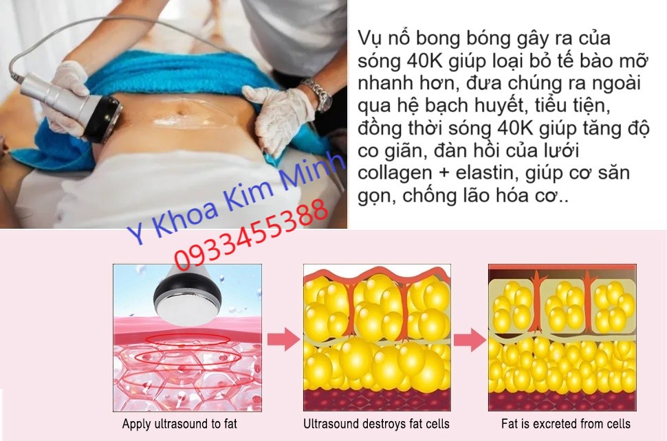 Máy đánh tan mỡ bụng body có hiệu quả làm giảm thể tích mỡ bụng body nhanh hơn