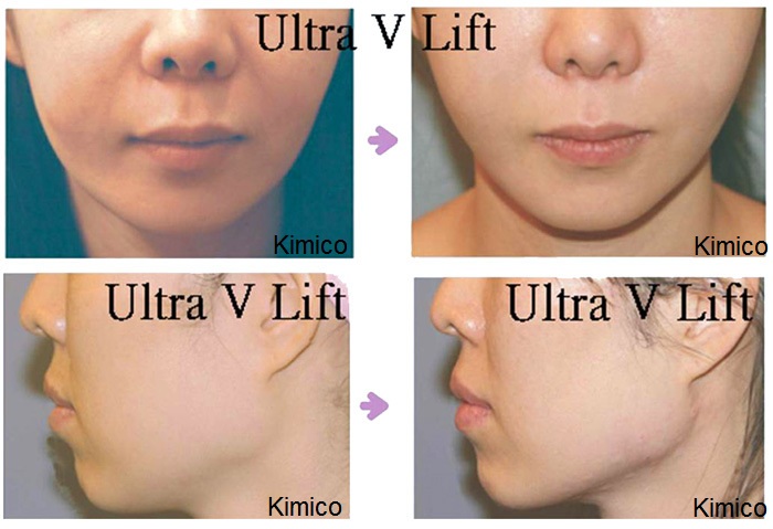 Học căng chỉ v&agrave;ng o dau tai Tp.HCM Sai Gon Y Khoa Kim Minh 95 đường Th&agrave;nh Th&aacute;i, F14, Q10, Tp.HCM