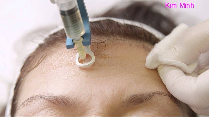 C&aacute;ch sử dụng s&uacute;ng bơm ti&ecirc;m mỹ phẩm thuốc v&agrave;o da BL038 Y Khoa Kim Minh