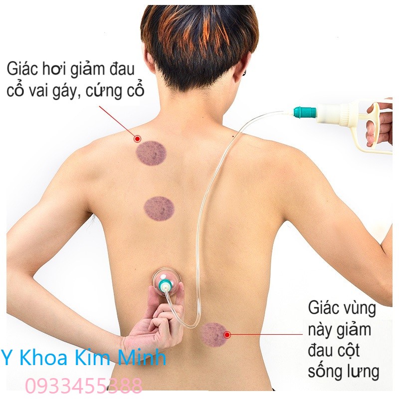 Hộp giác hơi 24 cốc không dùng lửa hộp giấy