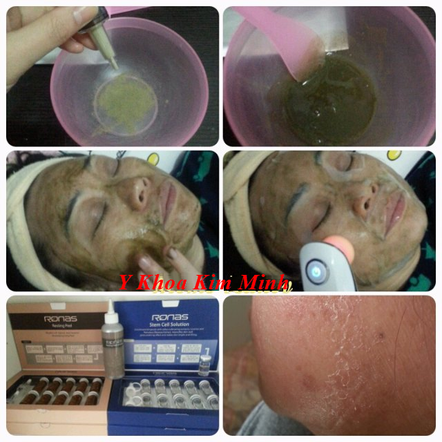 Hướng dẫn cách peel thay da sinh hoc Ronas - Y khoa Kim Minh Huong dan cach peel thay da sinh hoc Ronas Han Quoc - Y Khoa Kim Minh