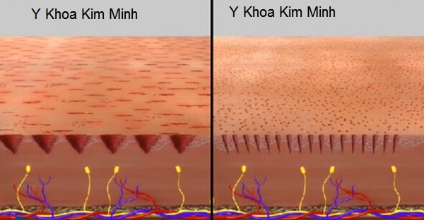Huong dan su dung cay lan kim dien Y Khoa Kim Minh