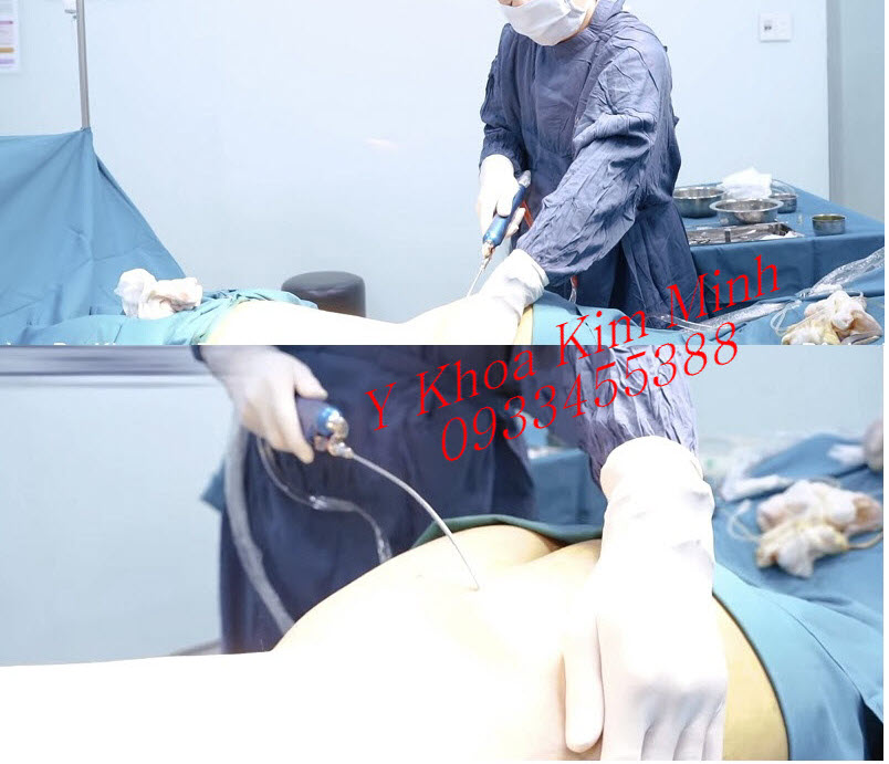 Hướng dẫn kỹ thuật phá mỡ, hút mỡ body