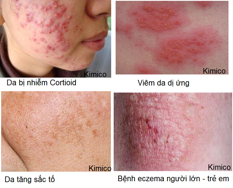 Kem dieu tri da tang sac to BS dung cho da bi nhiem cortioid, viem da di ung, da loang lo mau sac, benh Eczema kim minh
