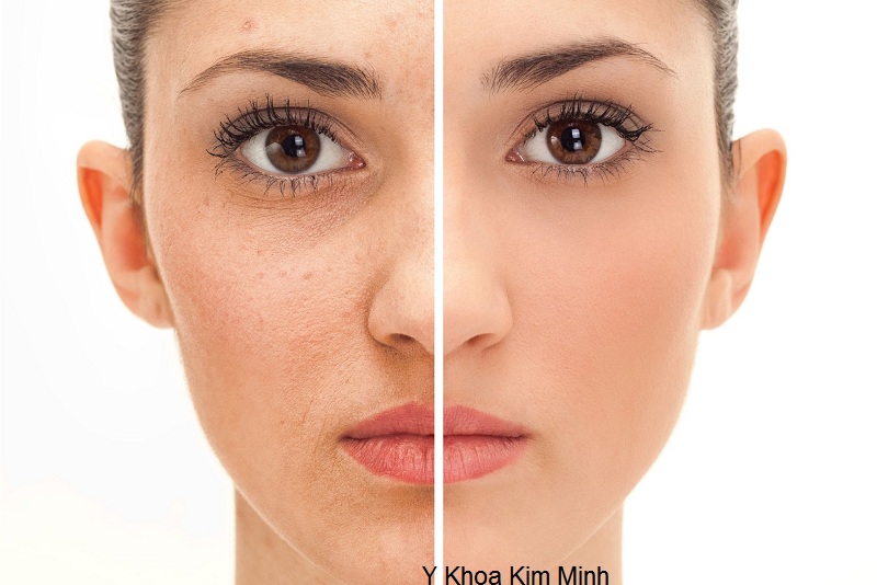 Kem dieu tri da ton thuong Q10 Premium ngan ngua da lao hoa ban tai Y Khoa Kim Minh