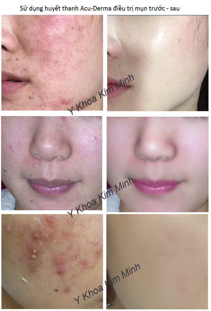 Kết quả điều trị mụn, da viêm mụn, dị ứng kích thích bằng huyết thanh Acu Derma BHA - Y khoa Kim Minh