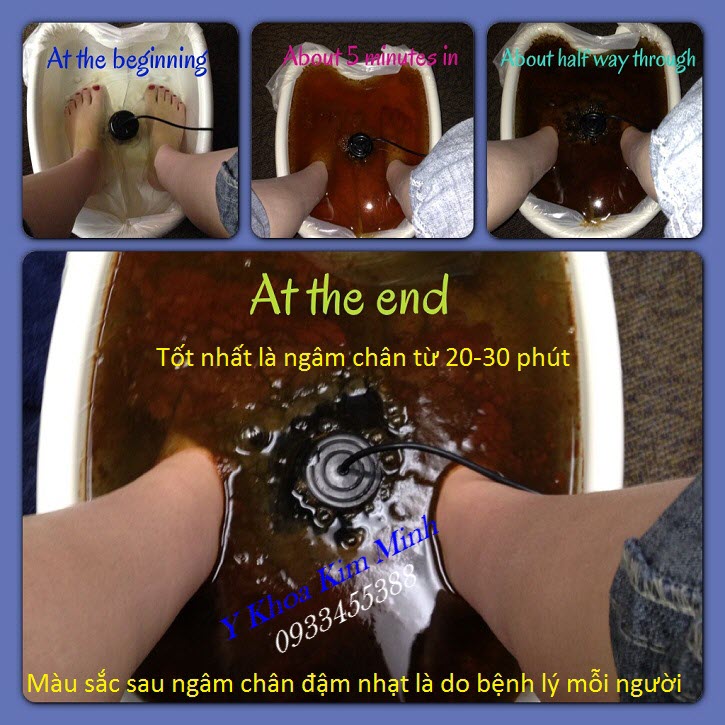 Kết quả trước và sau khi ngâm chân loại bỏ độc tố bằng máy ion KM-805C - Y Khoa Kim Minh