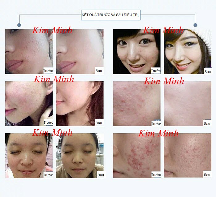 Kết quả trước và sau điều trị bằng vòm ánh sáng sinh học omega light 4 màu - Y khoa Kim Minh