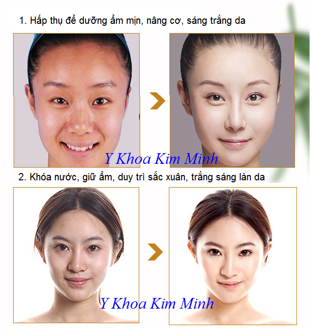 Kết quả trước và sau khi dùng serum vàng 24K Gold - Y khoa Kim Minh