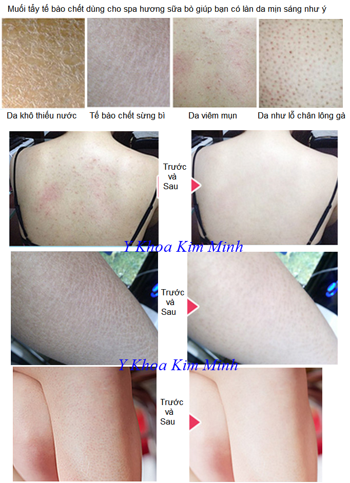 Kết quả sau sử dụng muối tắm milk spa dùng tẩy tế bào chết body - Y khoa Kim Minh