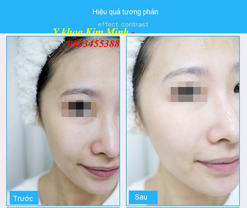 Kết quả tiêm căng bóng trắng mịn da tức thì bằng máy tiêm mesogun nano - Y khoa Kim Minh