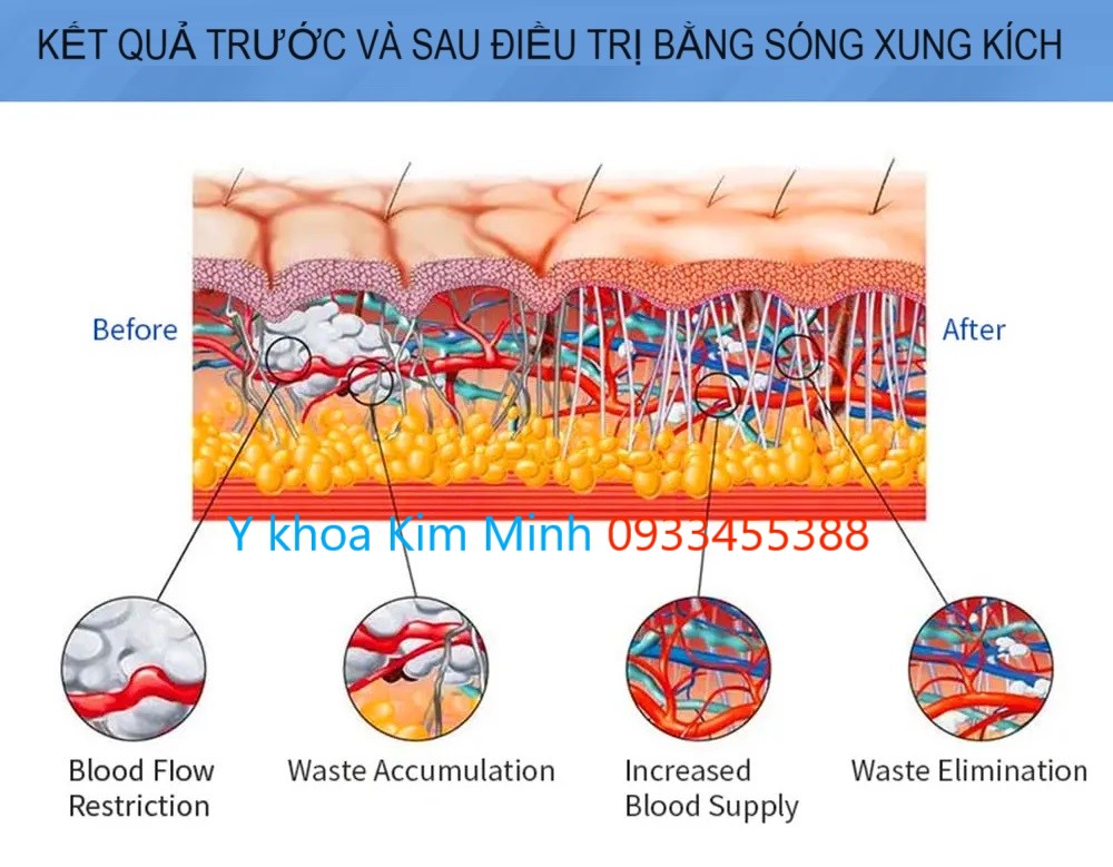 Kết quả trước và sau điều trị đau cơ xương khớp bằng máy xung kích T43