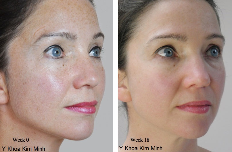 Te bao goc tao xoan lan kim tai tao tre hoa da Nhat Ban Y Khoa Kim Minh nhap khau