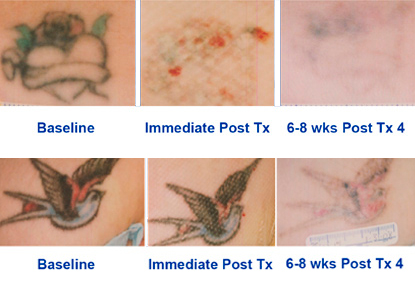 HDSD m&aacute;y x&oacute;a xăm laser YAG