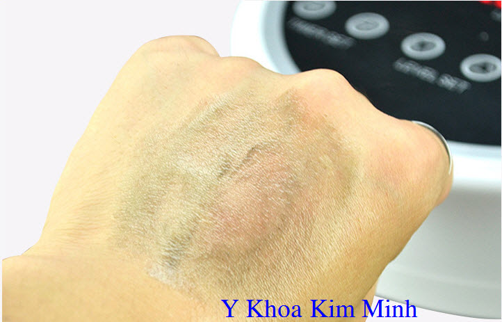 Loai bo doc to duoi da bang vien tay chi Haosani Y Khoa Kim Minh