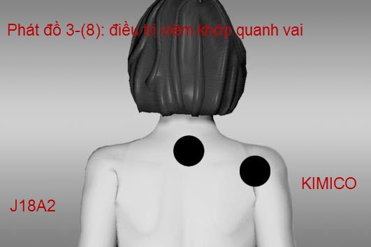 Chữa vi&ecirc;m đau quanh khớp vai bằng m&aacute;y trị liệu trung tần Đ&ocirc;ng &Aacute; J18A2 Y Khoa Kim Minh ph&acirc;n phối bảo h&agrave;nh 12 th&aacute;ng