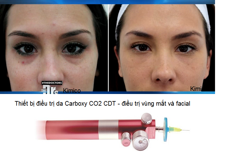 may dieu tri da vung mat va mat Carboxy CO2 CDT Y Khoa Kim Minh 0933455388