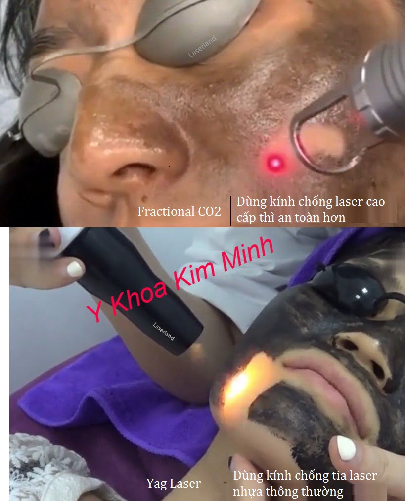 Kính chống tia laser | LaserLand