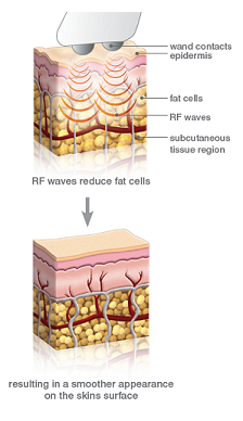 Máy trẻ hóa tái tạo da 