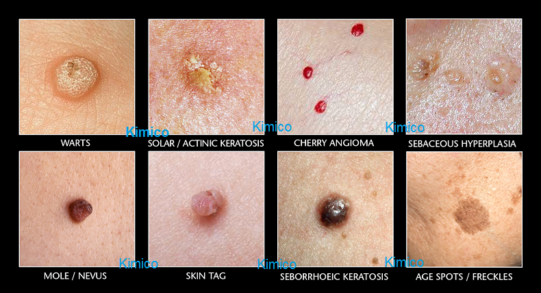 May xoa nam, dot not ruoi, quet tan nhang Mole Pen ban tai Y khoa Kim Minh