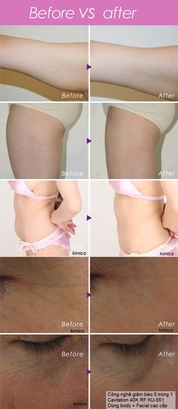 May giam beo da nang toan than Cavitation 40K RF KU-551 Y khoa Kim Minh