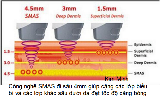May Hifu mini KM-003A sử dụng công nghệ SMAS đạt được sự căng bóng và sắp xếp tổ chức các lớp da