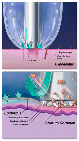 M&aacute;y trẻ h&oacute;a da tẩy tế b&agrave;o chết Hydro Microdermabrasion