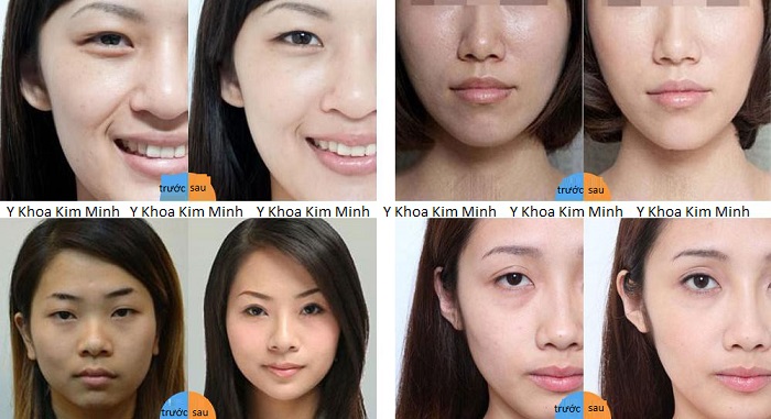 May bom tiem dien HA duong chat Y Khoa Kim Minh Hydro Injector Han Quoc