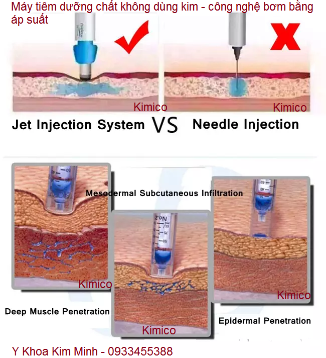 May tiem duong chat khong dung kim non-needle injection Korea Han Quoc Y Khoa Kim Minh Tp hochiminh