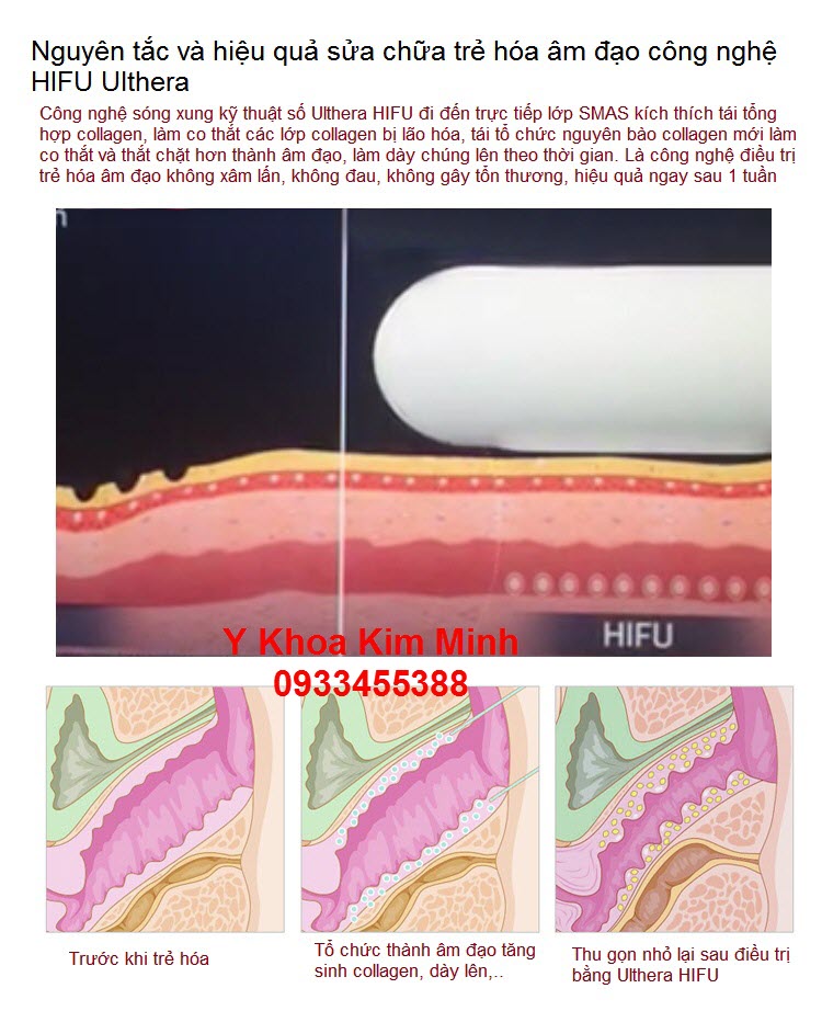 Cách trẻ hóa âm đạo SMAS Ulthera HIFU - Y khoa Kim Minh May tre hoa am dao bang cong nghe SMAS Ulthera HIFU V-258 - Y khoa Kim Minh