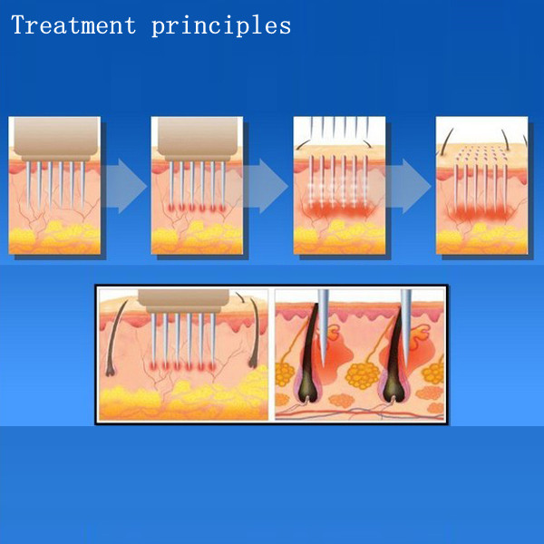 M&aacute;y trẻ h&oacute;a da l&agrave;m min da trị mụn RF mini
