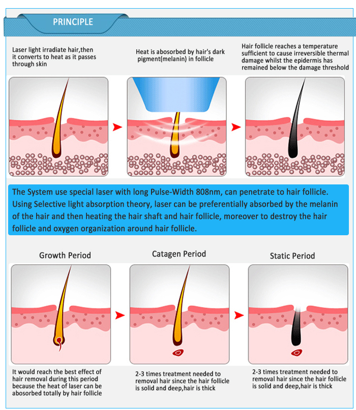 Công nghệ máy triệt lông IPL KGP-580