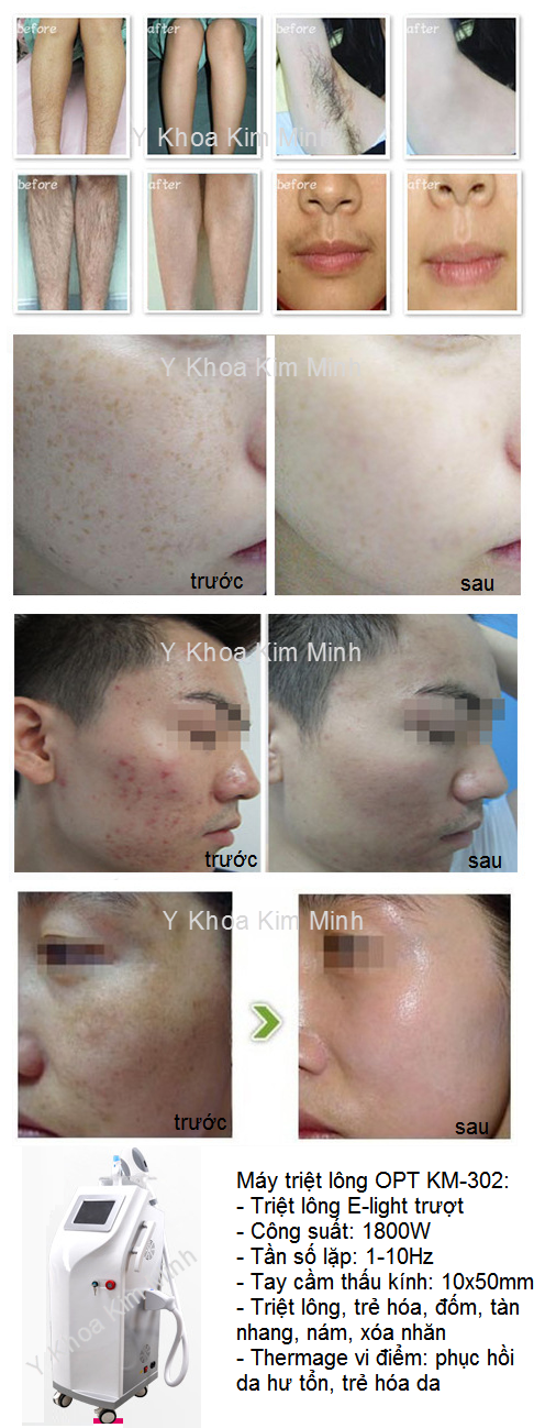 B&aacute;n m&aacute;y triệt l&ocirc;ng truot nhanh OPT KM-302 Y khoa Kim Minh