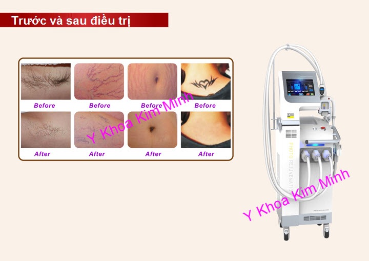 M&aacute;y triệt long nhanh ở đ&acirc;u b&aacute;n tốt nhất SHR EPL200 Y Khoa Kim Minh