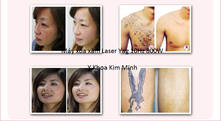 May laser yag xóa xăm tattoo V9