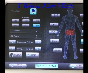 Máy xung kích chữa đau thần kinh tọa hiệu quả - Y khoa Kim Minh May xung kich chua dau than kinh toa - Y khoa Kim Minh