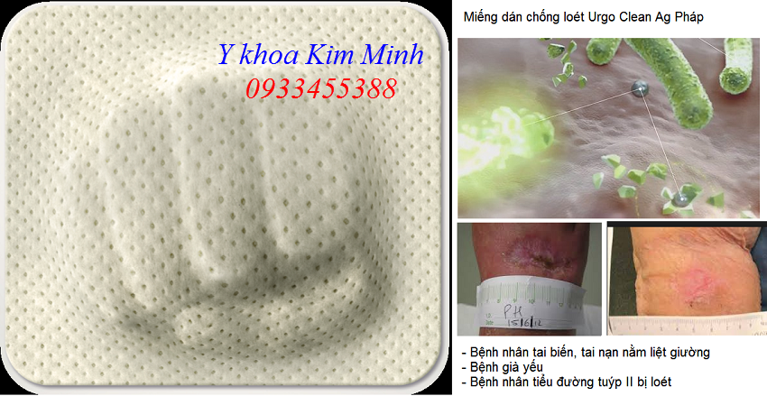 Urgo Clean Ag điều trị các vết loét vô cùng hiệu quả - Y khoa Kim Minh Miếng dán loét cho bệnh nhân tai biến, tiểu đường có vết thương lở loét Urgo Clean Ag - Y khoa Kim Minh 0933455388