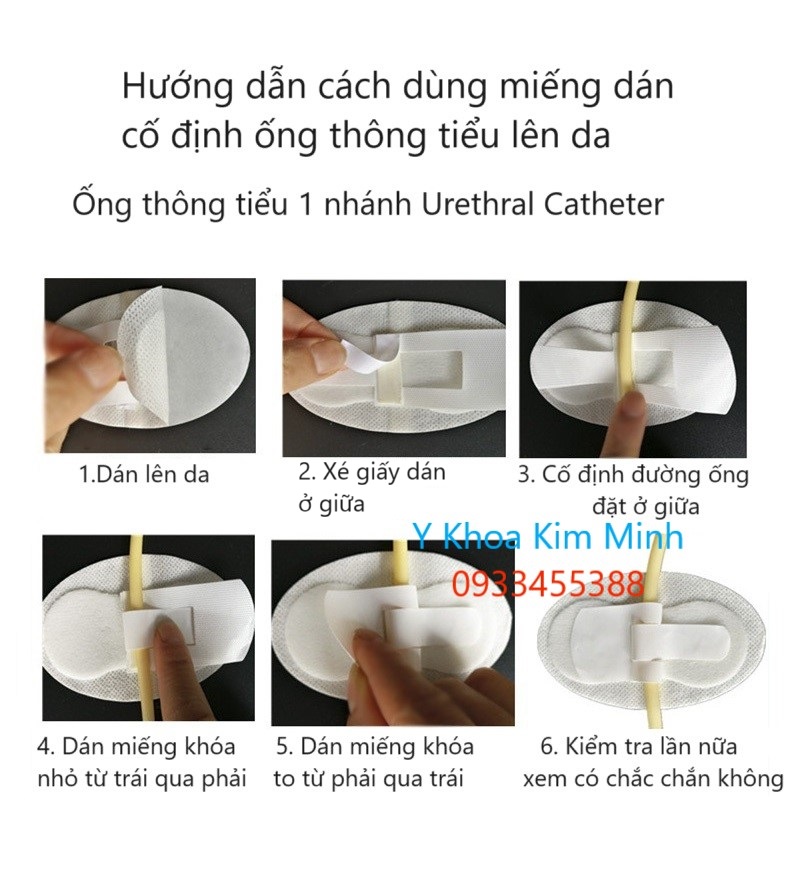 Hướng dẫn sử dụng miếng dán cố định ống thông tiểu 1 nhánh Urethral Catheter lên đùi bệnh nhân