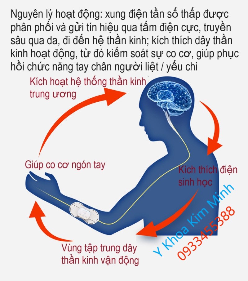 Nguyên lý hoạt động của máy EMS tập mạnh tay chân người liệt tai biến