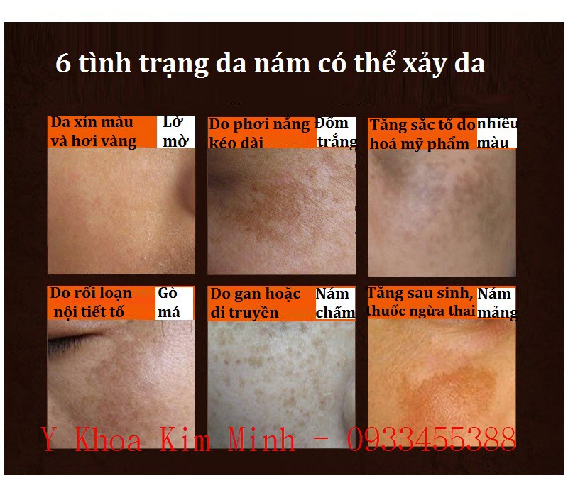 Nguyên nhân gây nám cho da mặt