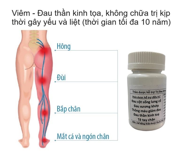Nguyên nhân gây đau thần kinh tọa và cách chữa trị