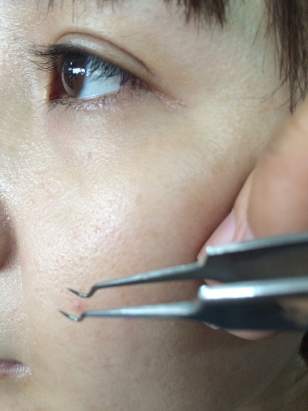 Nhíp gấp lấy mụn